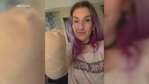 South Carolina woman’s hand amputated due to third-degree burns from hair dryer